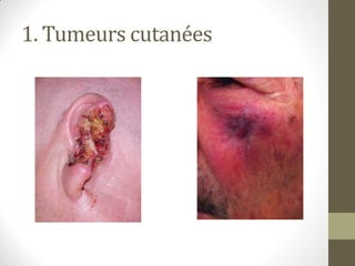 1. Tumeurs cutanées
 