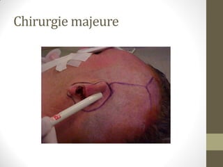 Chirurgie majeure
 