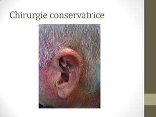 Chirurgie conservatrice
 