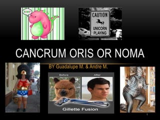 CANCRUM ORIS OR NOMA
BY Guadalupe M. & Andre M.

1

 