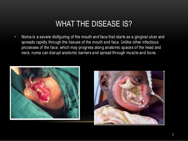 What Causes Noma Cancrum oris or noma