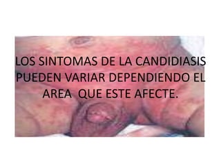 LOS SINTOMAS DE LA CANDIDIASIS
PUEDEN VARIAR DEPENDIENDO EL
     AREA QUE ESTE AFECTE.
 