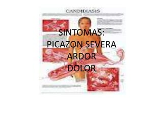 SINTOMAS:
PICAZON SEVERA
     ARDOR
     DOLOR
 