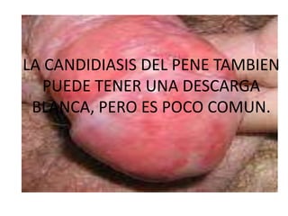 LA CANDIDIASIS DEL PENE TAMBIEN
   PUEDE TENER UNA DESCARGA
 BLANCA, PERO ES POCO COMUN.
 