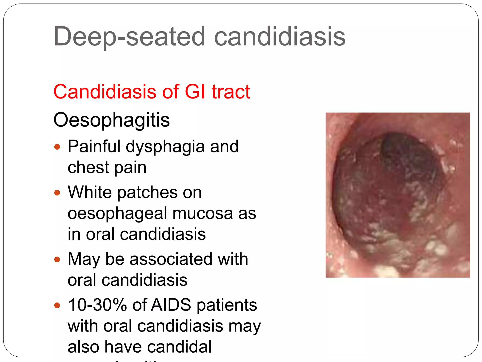 Deep-seated candidiasis
Candidiasis of GI tract
Oesophagitis
 Painful dysphagia and
chest pain
 White patches on
oesophageal mucosa as
in oral candidiasis
 May be associated with
oral candidiasis
 10-30% of AIDS patients
with oral candidiasis may
also have candidal
 