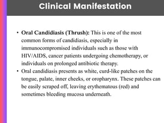 Clinical Manifestation
• Oral Candidiasis (Thrush): This is one of the most
common forms of candidiasis, especially in
immunocompromised individuals such as those with
HIV/AIDS, cancer patients undergoing chemotherapy, or
individuals on prolonged antibiotic therapy.
• Oral candidiasis presents as white, curd-like patches on the
tongue, palate, inner cheeks, or oropharynx. These patches can
be easily scraped off, leaving erythematous (red) and
sometimes bleeding mucosa underneath.
 