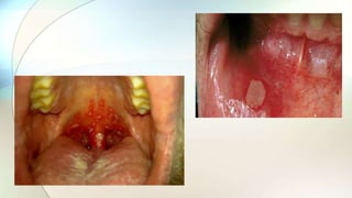 candidal infection.pptx