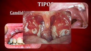 TIPOS
Candidíase Oral
 