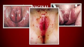 CANDIDÍASE VAGINAL
 