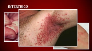 INTERTRIGO
 