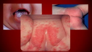 EM CERTOS CASOS PODE OCORRER A
TRANSMISSÃO DA MÃE PARA O BEBÊ
DURANTE O PARTO. OU AINDA, ATRAVÉS DE
SECREÇÕES DA BOCA, COMO NAS SITUAÇÕES
DE SAPINHO.
 