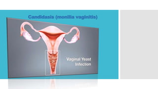 Candidasis (monilia vaginitis)
 