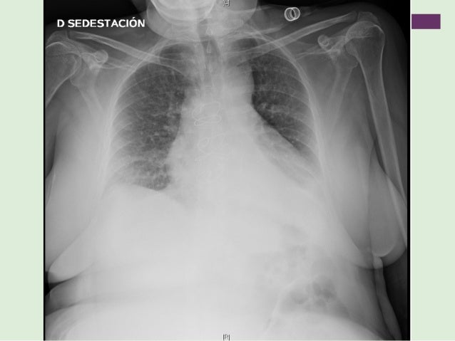 Candidemia en paicente pluripatologica Candidemia en paicente pluripatologica