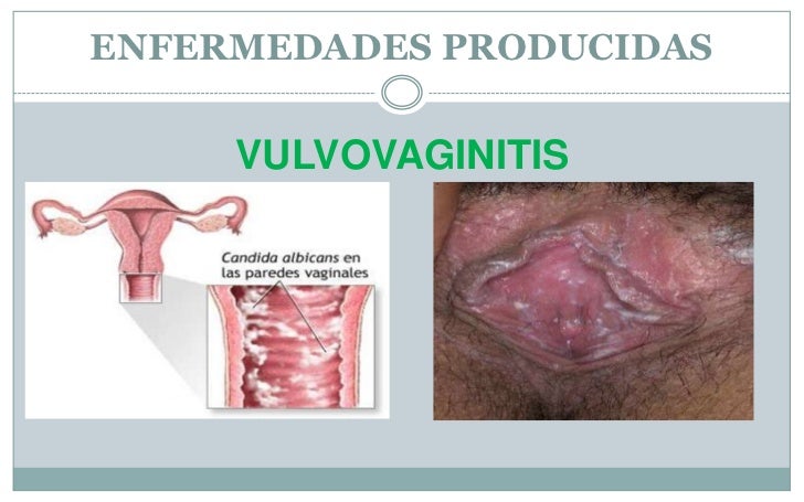 CANDIDA VAGINITIS (VAGINALE SCHIMMEL INFECTIE)