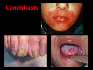 Candidiasis
 