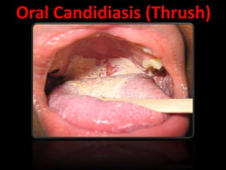 Oral Candidiasis (Thrush)
 