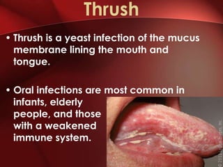 Thrush
• Thrush is a yeast infection of the mucus
  membrane lining the mouth and
  tongue.

• Oral infections are most common in
  infants, elderly
  people, and those
  with a weakened
  immune system.
 