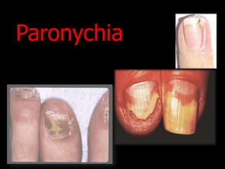 Paronychia
 