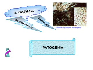 Candidiasis pulmonar hematógena.




PATOGENIA
 