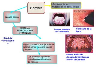 Infecciones de las
                                                   mucosas de la boca, lengua
                            Hombre

   aparato genital




                   SISTEMA                                                Comisura de la
                                                    Lengua infectada
                REPRODUCTOR                         con candidiasis       boca
                  FEMENINO

  Candidal
vulvovaginiti
     s
                     Vagina, comezón enrojecimiento,
                     dolor al orinar, desecho blanco
                     y espeso

                                                                severa infeccion
                         Los síntomas aparecen                  de pseudomembranas
                         cuando crece el numero                 A nivel del paladar
                         de hongos
 