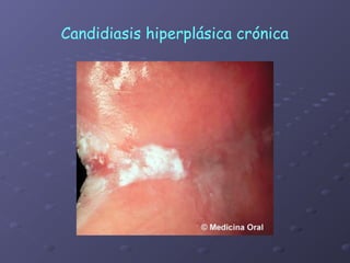 Candidiasis hiperplásica crónica
 