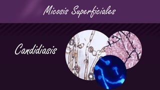 Micosis Superficiales
Candidiasis
 