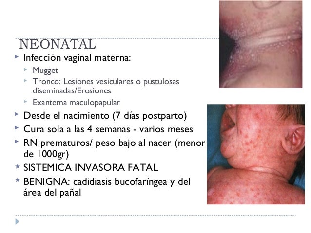 Candidiasis