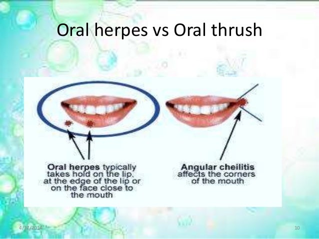 Symptoms of Throat Herpes | eHow