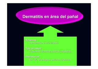 Dermatitis en área del pañal
••SSííntomas:ntomas:
••asintomasintomáática o nitica o niñño irritableo irritable
••Tipo de lesiTipo de lesióón:n:
••VesVesíículas, ampollas, ulceras o pculas, ampollas, ulceras o púústulas.stulas.
••DistribuciDistribucióón:n:
••EnEn ““WW””, en pliegues, perianal, artefacta, en pliegues, perianal, artefacta
 