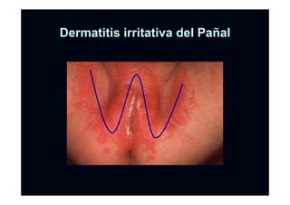 DermatitisDermatitis irritativairritativa del Padel Paññalal
 