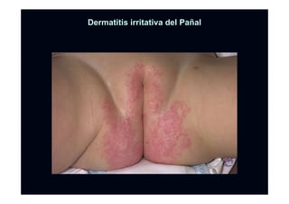 DermatitisDermatitis irritativairritativa del Padel Paññalal
 