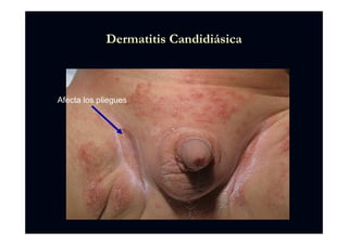 Dermatitis CandidiDermatitis Candidiáásicasica
Afecta los pliegues
 