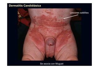 Se asocia con Muguet
Lesiones satélites
Dermatitis CandidiDermatitis Candidiáásicasica
 