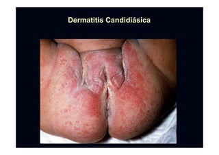 Dermatitis CandidiDermatitis Candidiáásicasica
 