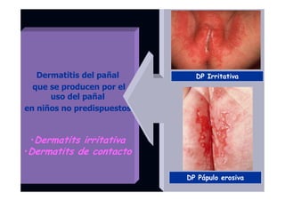 Dermatitis del pañal
que se producen por el
uso del pañal
en niños no predispuestos
•Dermatits irritativa
•Dermatits de contacto
DP Irritativa
DP Pápulo erosiva
 