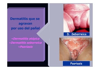 Dermatitis que se
agravan
por uso del pañal
•Dermatitis atópica
•Dermatitis seborreica
•Psoriasis
Psoriasis
D. Seborreica
 