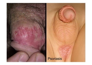 Psoriasis
 