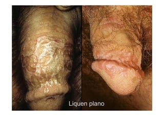 Liquen plano
 