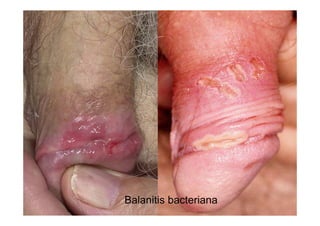 Balanitis bacteriana
 