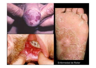 Enfermedad de Reiter
 