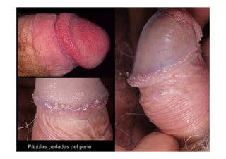 Pápulas perladas del pene
 