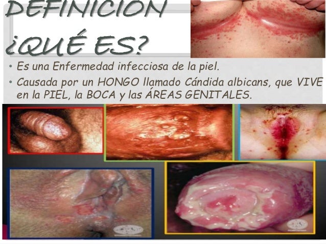 El arraigo de las uñas la causa y el tratamiento