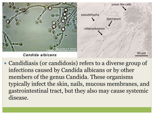 Candidiasis | PPT