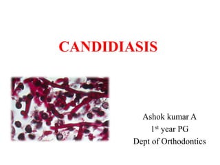 CANDIDIASIS
Ashok kumar A
1st year PG
Dept of Orthodontics
 