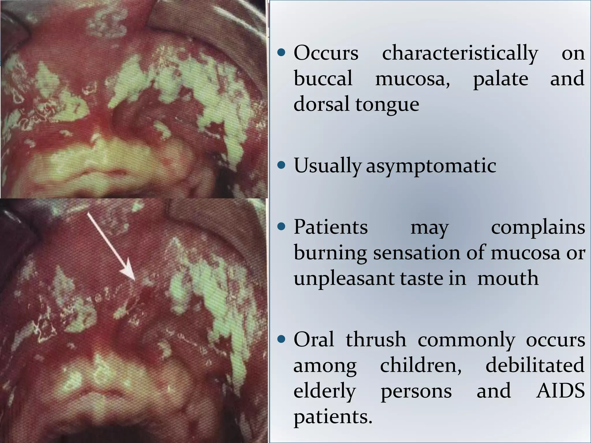  Occurs characteristically on
buccal mucosa, palate and
dorsal tongue
 Usually asymptomatic
 Patients may complains
burning sensation of mucosa or
unpleasant taste in mouth
 Oral thrush commonly occurs
among children, debilitated
elderly persons and AIDS
patients.
 