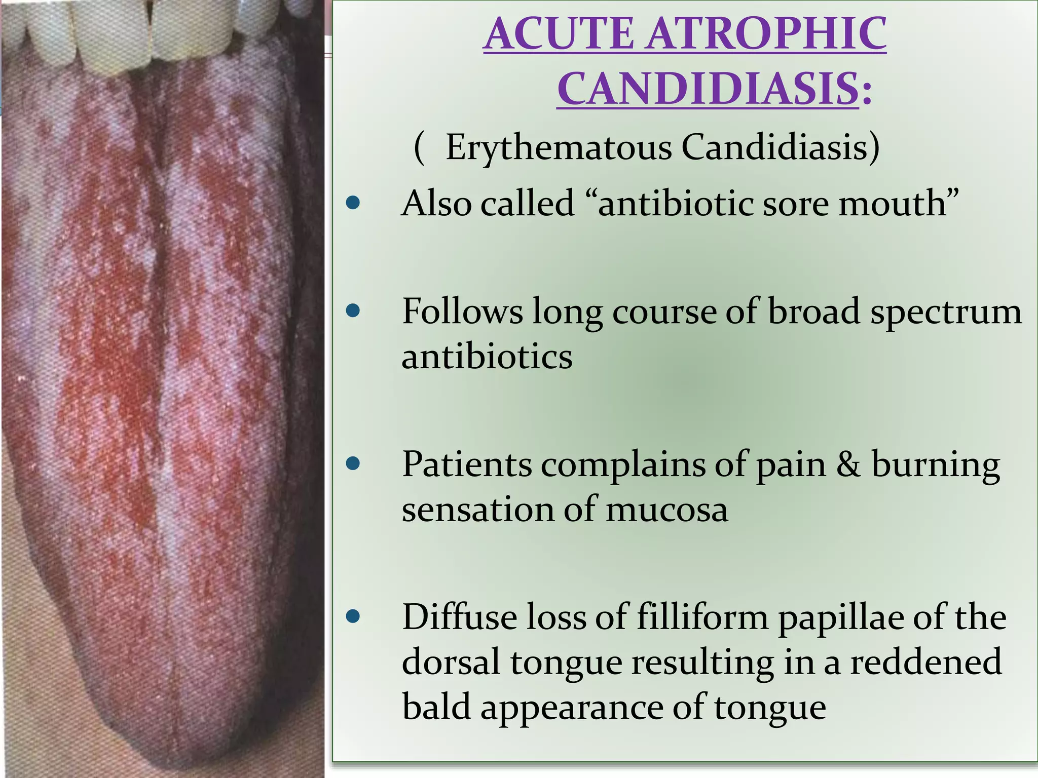 ACUTE ATROPHIC
CANDIDIASIS:
( Erythematous Candidiasis)
 Also called “antibiotic sore mouth”
 Follows long course of broad spectrum
antibiotics
 Patients complains of pain & burning
sensation of mucosa
 Diffuse loss of filliform papillae of the
dorsal tongue resulting in a reddened
bald appearance of tongue
 