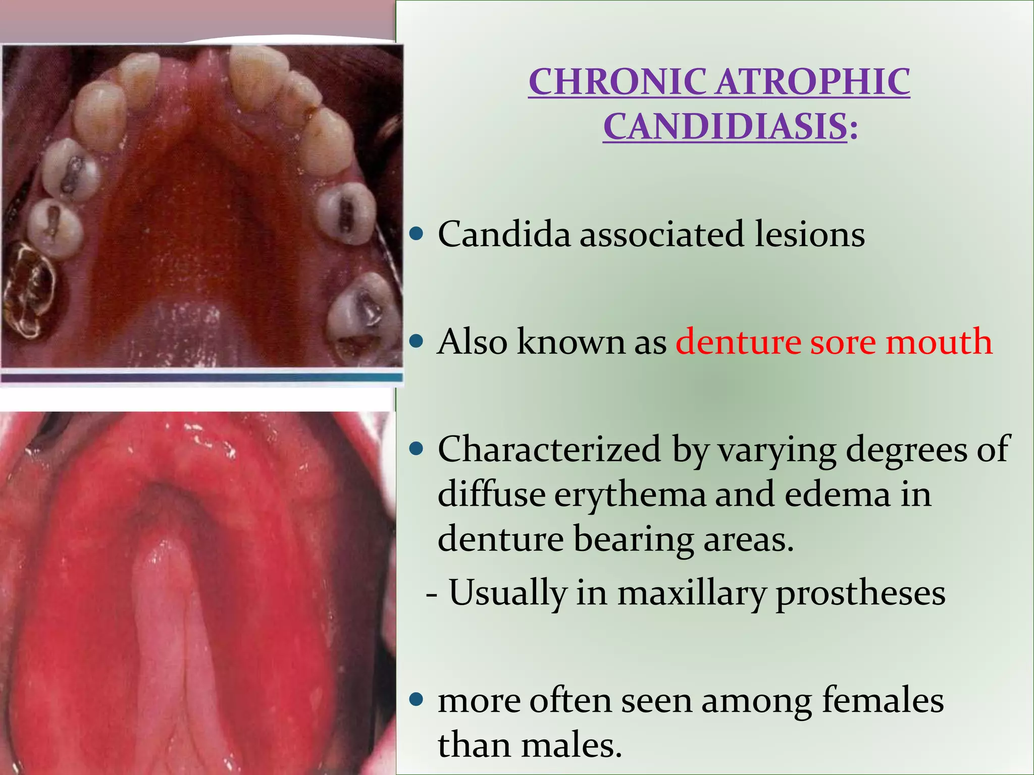 CHRONIC ATROPHIC
CANDIDIASIS:
 Candida associated lesions
 Also known as denture sore mouth
 Characterized by varying degrees of
diffuse erythema and edema in
denture bearing areas.
- Usually in maxillary prostheses
 more often seen among females
than males.
 