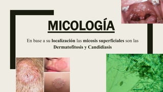 MICOLOGÍA
En base a su localización las micosis superficiales son las
Dermatofitosis y Candidiasis
 