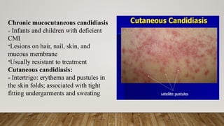 Sweat Rash Intertrigo CANDIDIASIS: VIRULENCE FACTORS, PATHOGENESIS & LABORATORY DIAGNOSIS | PPTX