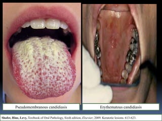 Pseudomembranous candidiasis Erythematous candidiasis
Shafer, Hine, Levy, Textbook of Oral Pathology, Sixth edition, Elsevier; 2009. Keratotic lesions. 613-623.
 